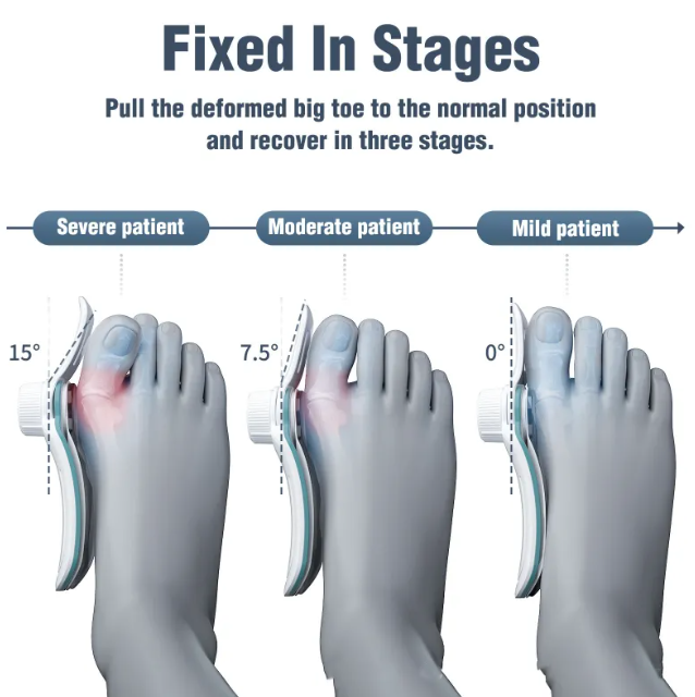 Adjustable Thumb Valgus Corrector Orthosis for Men and Women (3-Board, Varying Degrees)